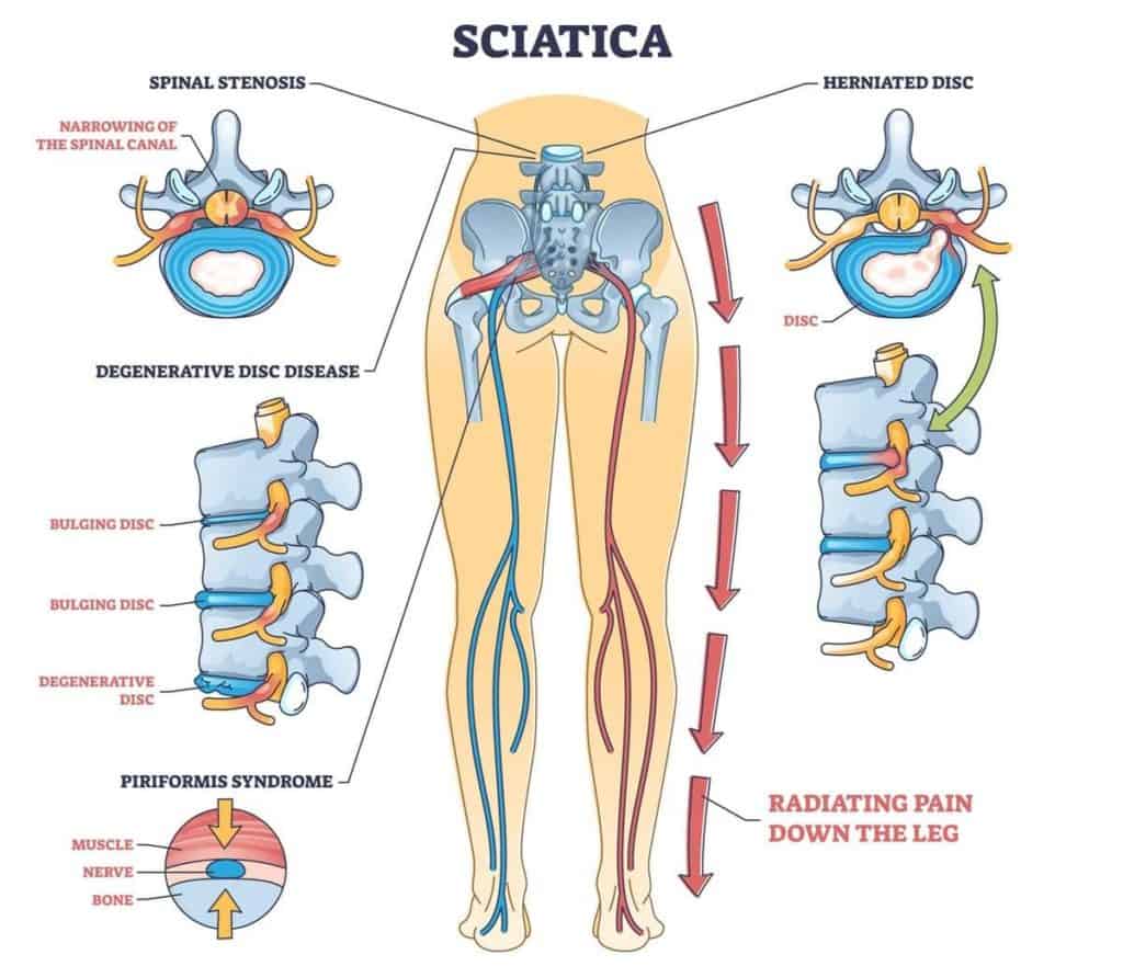 Causes of sciatica