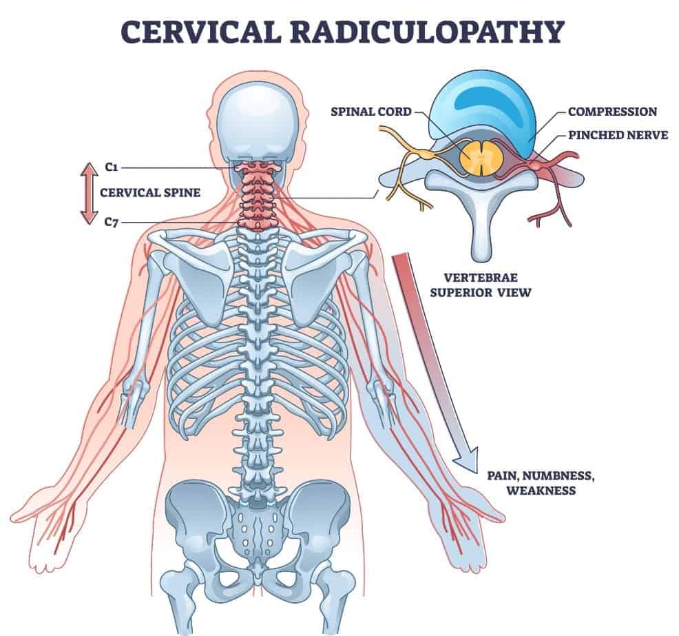 anatomy of the cervical radiculopathy or pinched nerve in the neck that cause tingling and numbness in the hand