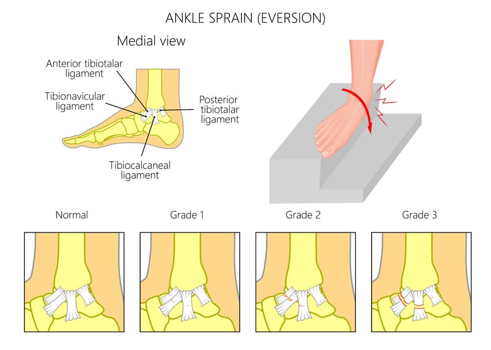 Anatomy and grades of the eversion ankle sprain