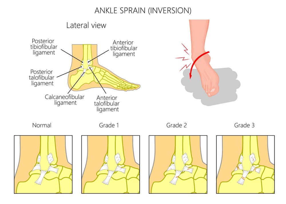 Anatomy and grades of the inversion ankle sprain