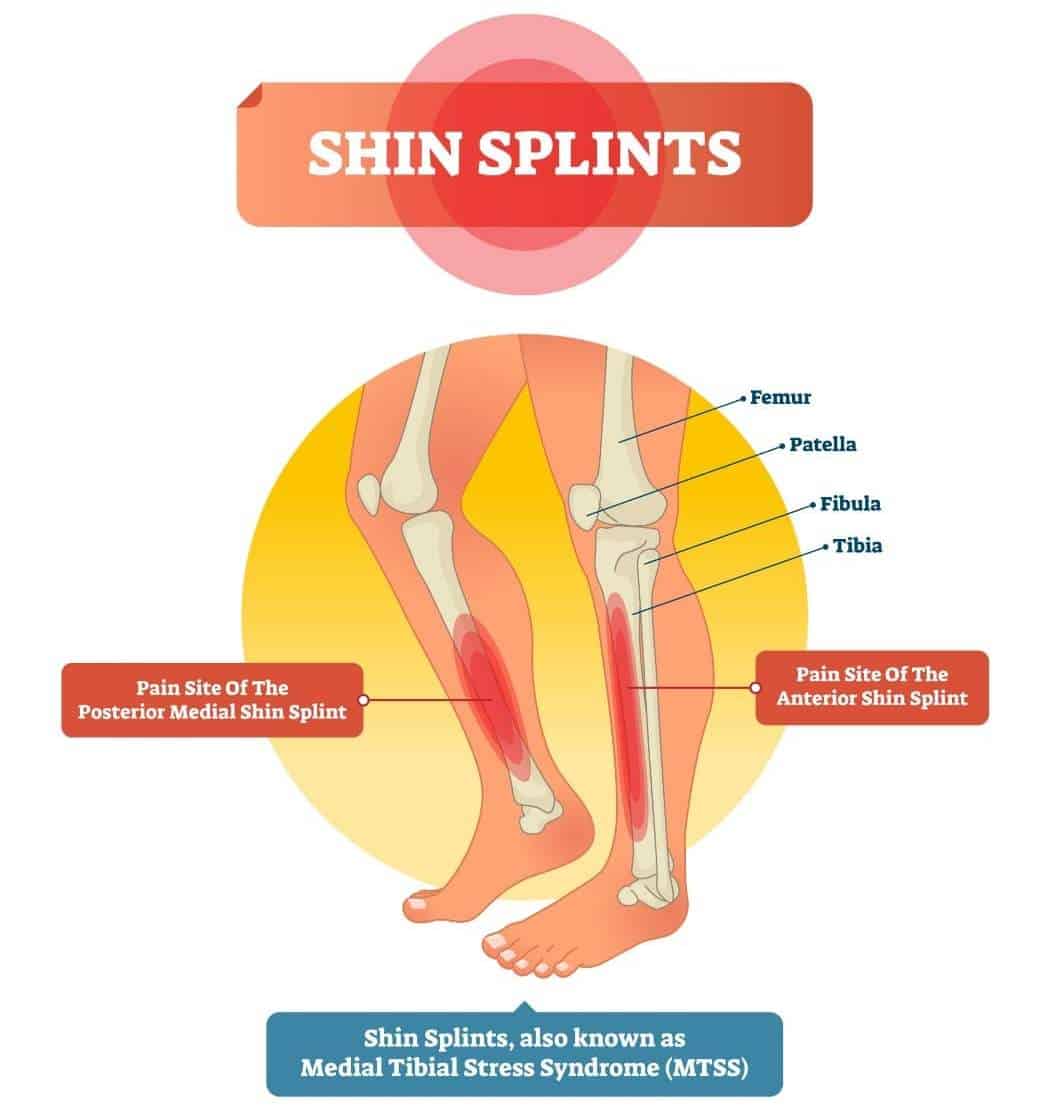 Definition and Anatomy of Shin Splints