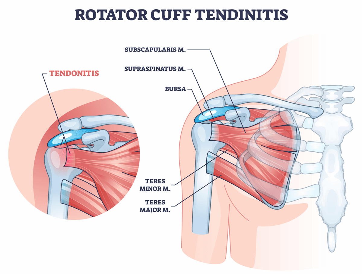 Rotator Cuff Tendonitis