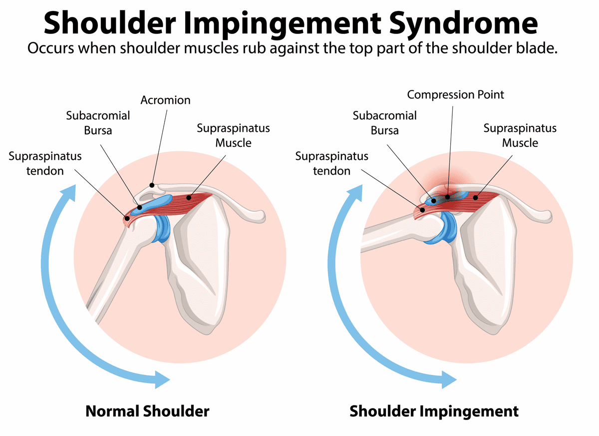 Shoulder Impingement