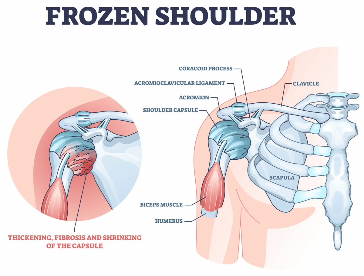 Frozen Shoulder