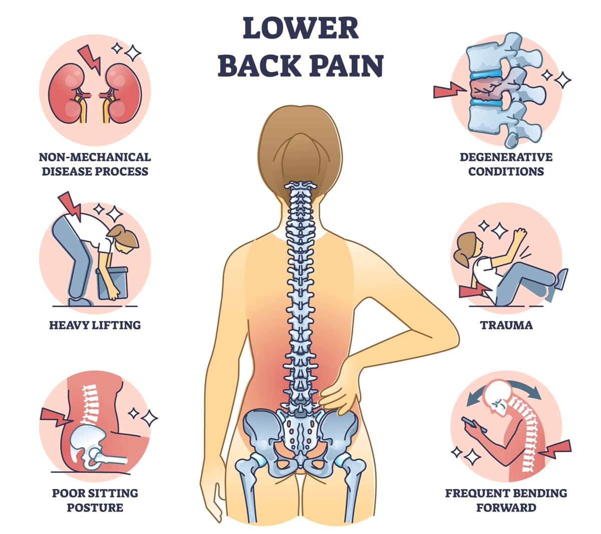 Common Causes of Lower Back Pain