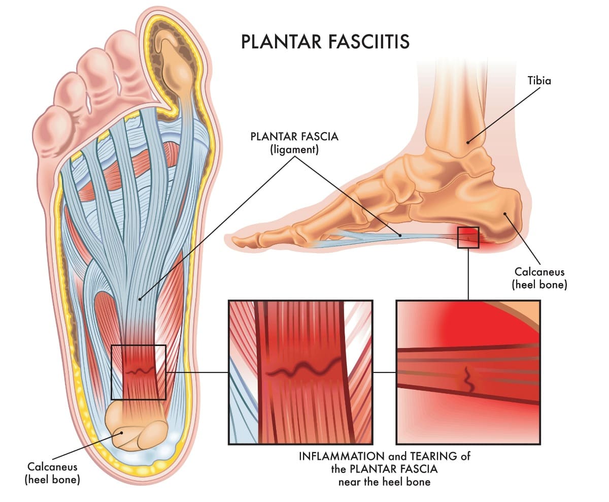 Anatomy of the Plantar Fascia