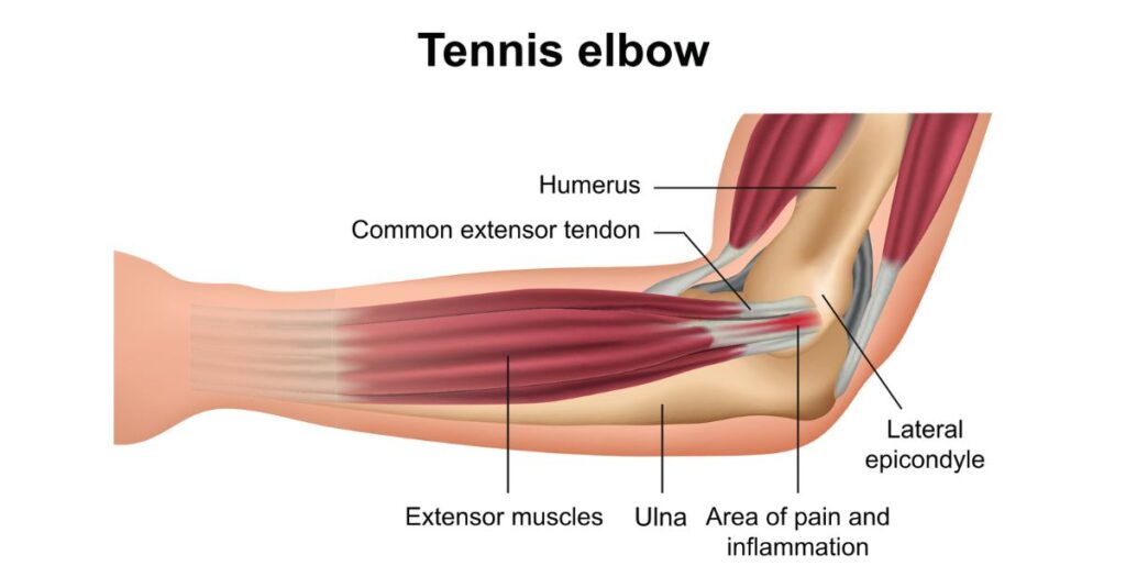 Tennis Elbow Keeps Coming Back Hangzhou Sports Medicine What the Data Shows: A Global Pattern?